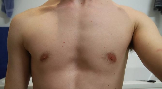 ‘Kunduracı göğsü’ dolgu estetikle normale dönebiliyor