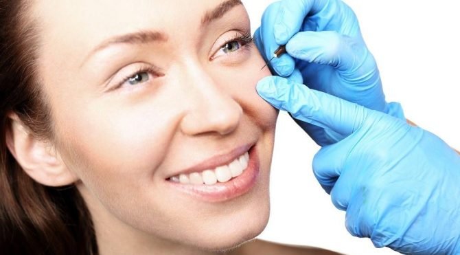 Milia nedir? Milia tedavisi nasıl yapılır?